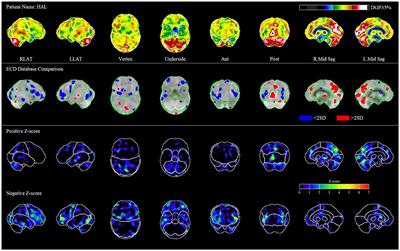 Using Single-Photon Emission Computerized Tomography on Patients With Positive Quantitative Electroencephalogram to Evaluate Chronic Mild Traumatic Brain Injury With Persistent Symptoms